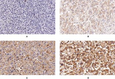 Value of Immunohistochemical Expression of Apelin, Succinate Dehydrogenase B, Chromogranin B, Human Epidermal Growth Factor Receptor-2, Contactin 4, and Succinyl-CoA Synthetase Subunit Beta in Differentiating Metastatic From Non-Metastatic Pheochromocytoma and Paraganglioma